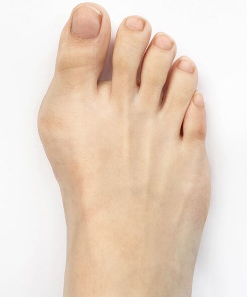 Alluce valgo prima di utilizzare lo spray Hondro Sol Valgus