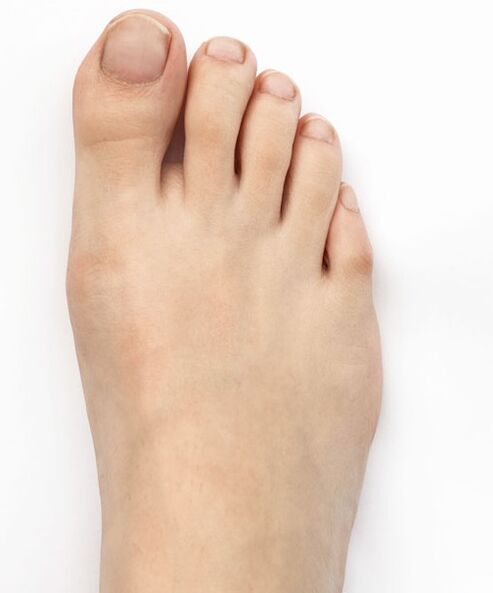 Ho guarito il mio pollice valgo con lo spray Hondro Sol Valgus