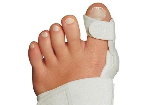 Deformazione valgus