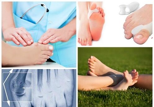 Trattamento della deformazione Valgus